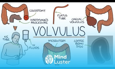 Learn Understanding Volvulus Twisted Bowel Mind Luster