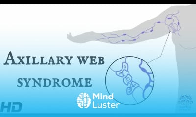 Learn Axillary Web Syndrome Everything You Need To Know - Mind Luster