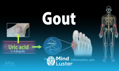 Learn Gout Pathophysiology Causes Symptoms Risk Factors Diagnosis and ...