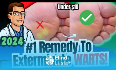 Learn 1 BEST Plantar Wart Removal How To Get Rid of Warts Treatments ...